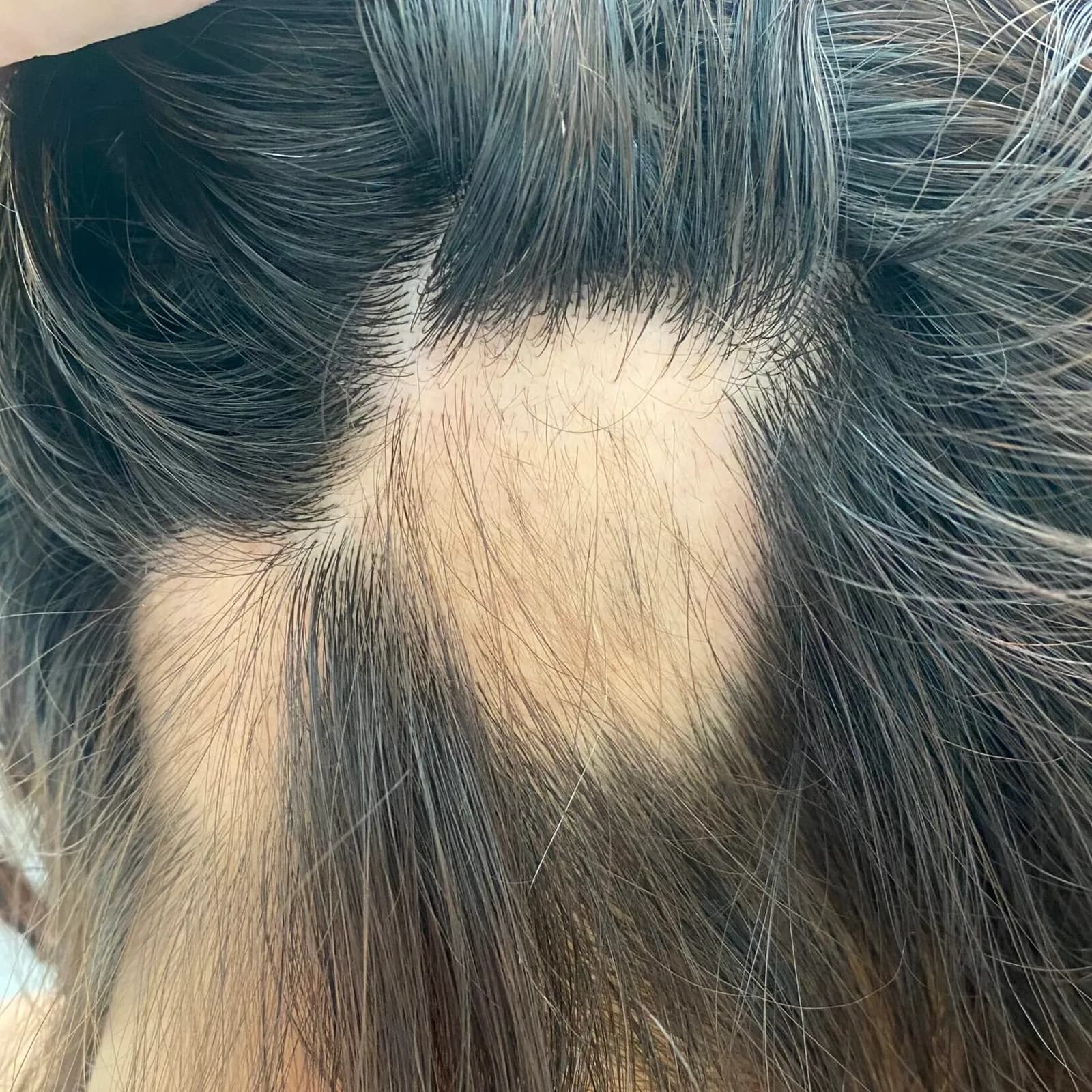 ALOPECIA