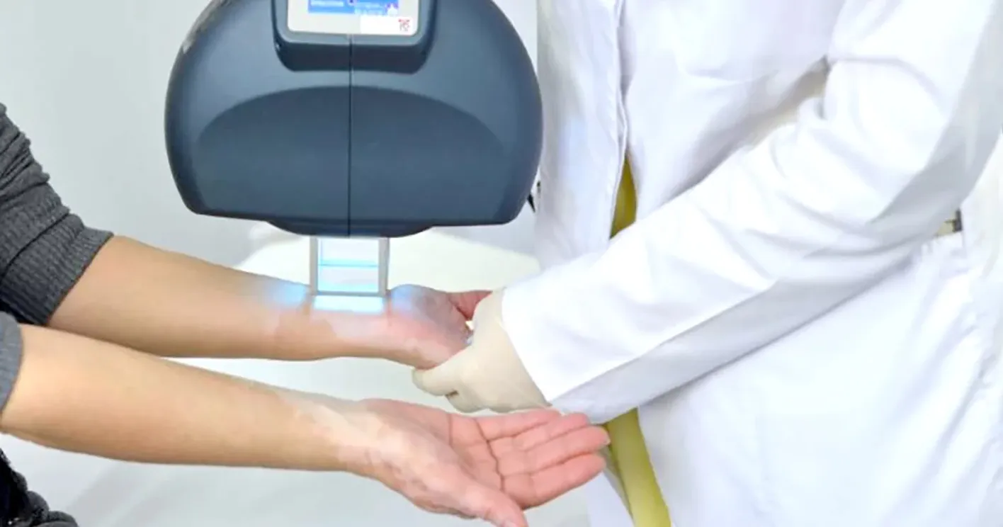 TRATAMIENTO DE VITILIGO CON EXCIMER LASER
