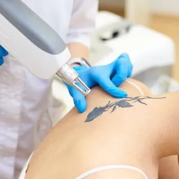 TRATAMIENTO DE TATUAJES CON LASER STARWALKER