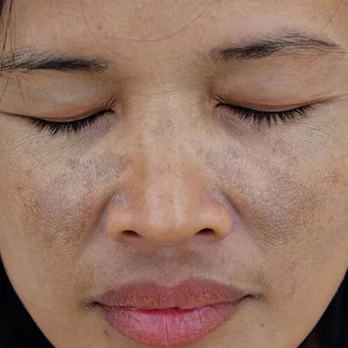 TRATAMIENTO DE MELASMA CON LASER STARWALKER