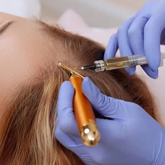 MESOTERAPIA CAPILAR