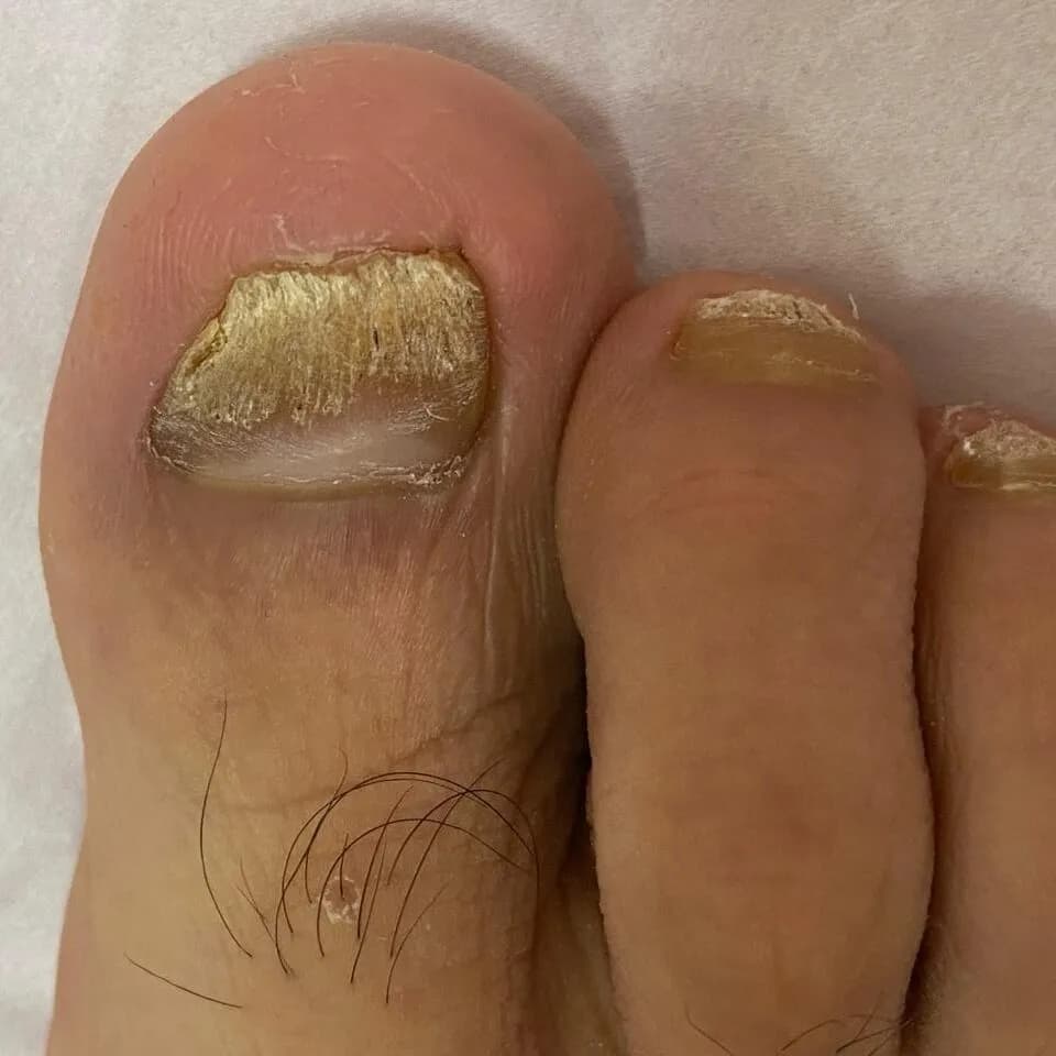 HONGOS EN UÑAS