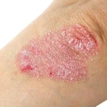 PSORIASIS