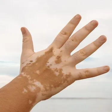 VITILIGO